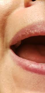 White spots on lips pictures. Skin Concerns Fordyce Granules Of The Lip How The Heck Do I Get Rid Of These Things I Have A Lot Of Products Made By The Ordinary If You Think Anything From