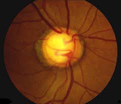 Image result for Glaucoma