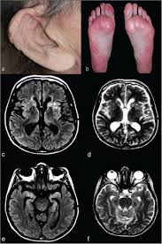 Image result for Relapsing Polychondritis