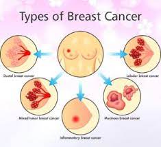 Kudal cancer symptoms in tamil,breast cancer symptoms in tamil language,mouth cancer symptoms in tamil,throat cancer symptoms in tamil language. Breast Cancer Dr V Ashwin Karuppan