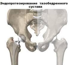 Endoprotezirovanie Tazobedrennogo Sustava Gorodskaya Klinicheskaya Bolnica Im F I Inozemceva