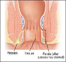 Image result for Perianal Abscess