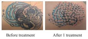 Maybe you would like to learn more about one of these? Eclipse Micropentr Non Laser Tattoo Removal Lase Away Hair Skin Solutions 508 480 5793lase Away Hair Skin Solutions 508 480 5793