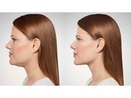 Plastic surgeons use a variety of procedures to remove a double chin. Ways To Get Rid Of Double Chin Fast