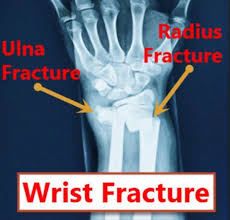 Image result for Wrist XRay