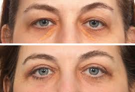 Image result for xanthelasma of eyelid