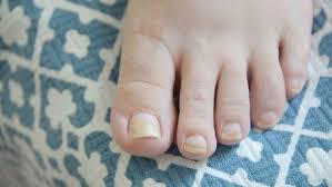 Cancer treatments may increase the likelihood of developing nail fungus. What Can You Do About Yellow Nails Ohio State Medical Center