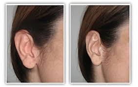 Cependant, d'autres facteurs sont évidemment à prendre en considération pour ne pas être déçu lors de l'utilisation. Otoplastie Chirurgie Des Oreilles Decollees Indications Techniques Remboursement Suites Et Cout Doctissimo