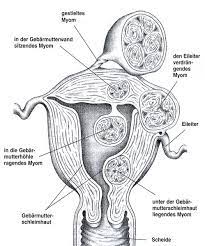 Kadın pelvisinde (havsala, leğen kemiği bölgesi, kasık) görülen en sık büyüme tipidir. Gebarmuttermyome Behandlung Diagnose