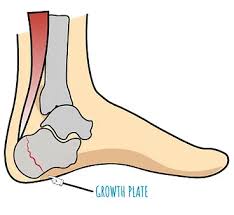 Image result for Calcaneal Apophysitis