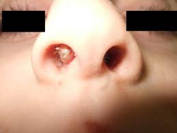 Nasal polyps (np) are noncancerous growths within the nose or sinuses. Nasal Obstruction In Children Sciencedirect