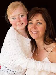 Epidermolysis bullosa: Disease is 'worst you've never heard of'