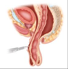 Image result for Rectal prolapse