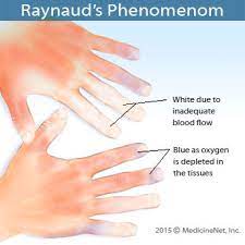 Raynaud S Phenomenon And Disease Treatment Symptoms Causes