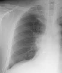 Image result for Broncholithiasis