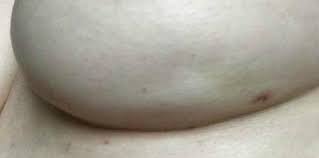 Ini juga boleh bermakna bahawa tumor lebih besar daripada 5 cm, dan kumpulan kecil. Penyakit Payudara Berkait Dengan Kanser Ini Cara Mengesan Dari Awal Theasianparent Malaysia
