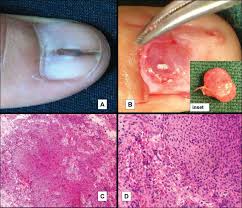 Image result for Glomus tumor