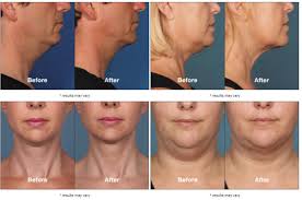 In other words, as long as you don't gain fat around your you may need more than one kybella treatment, depending on the amount of submental fat located underneath the chin and around your jawline. Botox North Denver Co Uptown Medical Aesthetics