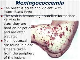 Doctors call septicemia (a bloodstream infection) caused by neisseria meningitidis meningococcal septicemia or meningococcemia. Meningococcal Infection Online Presentation