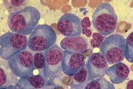 Image result for Multiple Myeloma