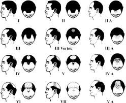 Although it is a similar process in males and females, this type of alopecia in ladies follows a slightly different balding pattern. Androgenic Alopecia Sciencedirect