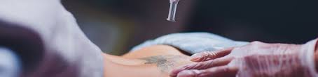 For this surgical removal of a tattoo, local anesthetic is used to numb the area before the surgery. Tattoo Removal Impulse Skin Laser Richmond S Premier Spa