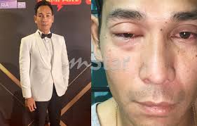 Bengkak ini juga tidak sakit, malah pesakit juga mampu untuk berjalan seperti biasa. Sepihan Motor Masuk Mata Buku Lali Bengkak Riz Amin Dilanggar Motor Sepupu Sendiri Hiburan Mstar