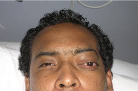 Image result for Proptosis