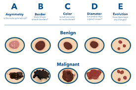With information about melanoma stages, prognosis is then possible. Skin Cancer Western New York Dermatology