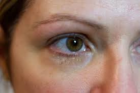How To Get Rid Of Milia Under The Eye Ehow Forehead Acne Homemade Wrinkle Cream Cystic Acne Treatment