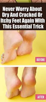 Never Worry About Dry And Cracked Or Itchy Feet Again With This Essential Trick In 2020 Health Body Tips