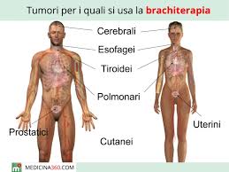 La radioterapia viene usata per le forme tumorali sensibili ai raggi, per lo più: Brachiterapia Cos E Procedura Tipi Ed Effetti Collaterali