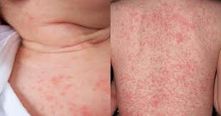 Image result for sweat rash on back baby