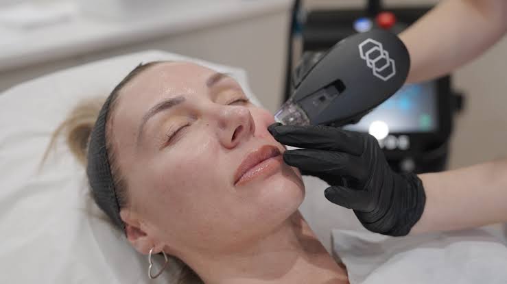 Morpheus8 Burst Wirral | Advanced Skin Tightening
