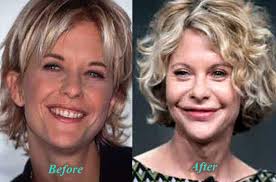 Meg ryan plastic surgery before after. Meg Ryan Plastic Surgery Lip Augmentation Before After Picture