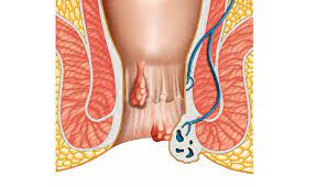 Can Piles Be Treated Without Surgery Apollo Spectra