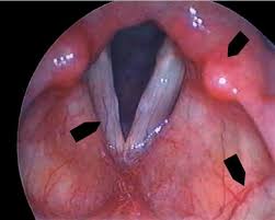 Image result for Chronic Laryngitis