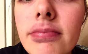 Hold the warm compress on the blind pimple for 10 to 15 minutes. Pin On My Friends