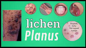 Lichen Planus Homeopathic Treatment Everything You Need To Know To Treat Homeopathically A A A A A A A ªa A A A A Autoimmunity Expert Dr Makkar