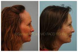 This 54 Year Old Woman Underwent Female Hairline Lowering And Is Shown Before And 1 Year After Hair Tr Hair Transplant Women Hair Transplant Hair Loss Remedies