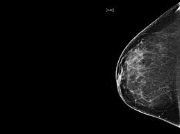 Women aged 50 to 74 years who had received a mammogram or breast cancer screening within the about 77.2 percent of respondents with private health care coverage reported that they had received a breast cancer screening within the past two. Mammograms More Likely To Cause Unneeded Treatment Than To Save Lives
