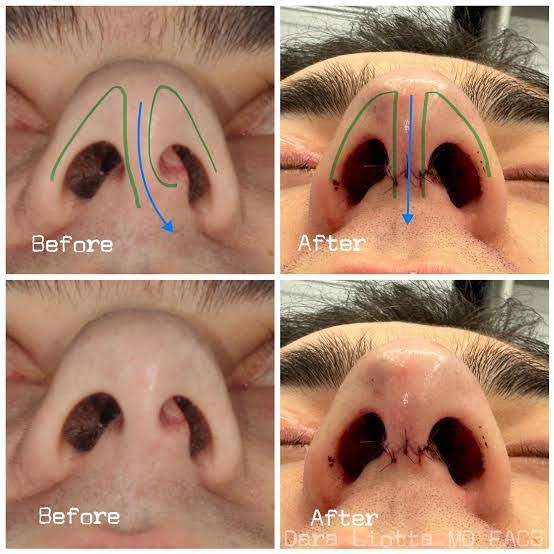 NOSE SURGERY product image