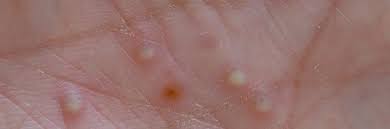 Image result for Pustule