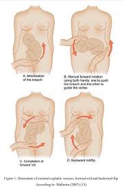 Image result for External Cephalic Version