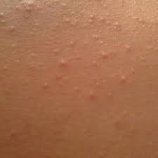 How to get rid of back acne for good, according to an expert. How To Get Rid Of Sweat Pimples Pimples Pimples On Forehead Oily Skin Treatment
