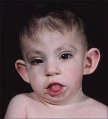 An epicanthic fold, epicanthal fold, or epicanthus is a skin fold of the upper eyelid (from the nose to the inner side of the eyebrow) covering the inner corner (medial canthus) of the eye. Child Who Has Kabuki Syndrome Note Epicanthal Folds Eversion Of Download Scientific Diagram