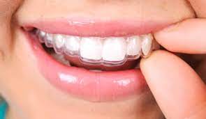Mouth guard for bruxism what is a custom night guard? How Effective Are Invisalign Braces And What S The Cost