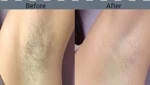 Laser Hair Removal For Blonde Hair Off 62 Online Shopping Site For Fashion Lifestyle
