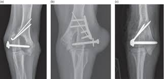 Image result for Lateral Condyle Fracture