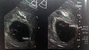At 6 weeks 4 days, you should see a gestational sac in the uterus. 6 Weeks Pregnant With Twins Belly Pictures Symptoms Ultrasound About Twins